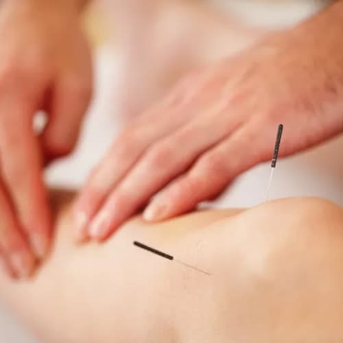 Acupuncture treatment in North Vancouver