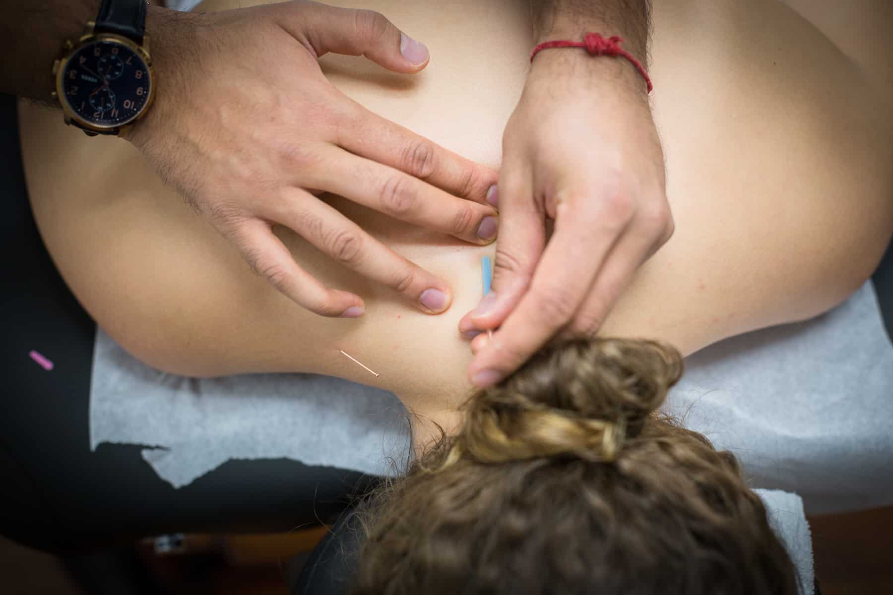 Active Therapy Acupuncturist during a session in North Vancouver