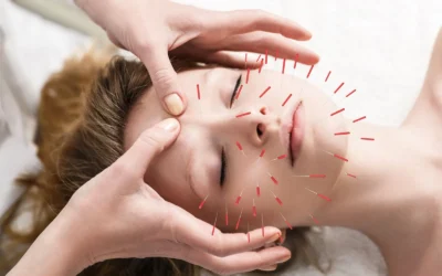 Top 10 Reasons Why You Should Try Acupuncture