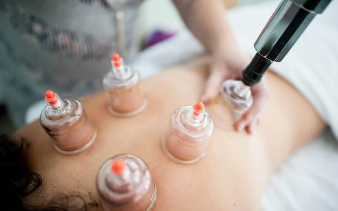 Cupping Therapy: Definition, Benefits & More